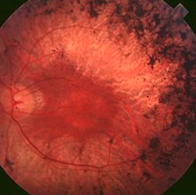optica-zires-retinosis-pigmentaria